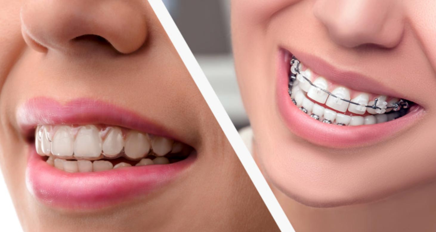 Teeth Alignment